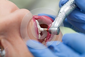 Close-up medical dentist procedure of teeth polish