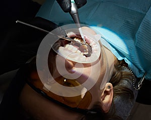 Close-up of medical dentist procedure teeth polishing in modern clinic