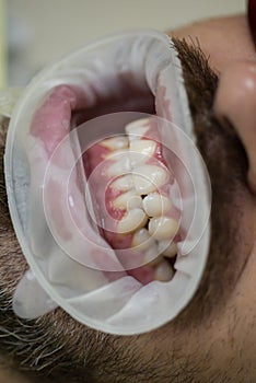 Close up of men patient with open mouth in medical chair. Doctor with assistant making teeth check up in dental clinic