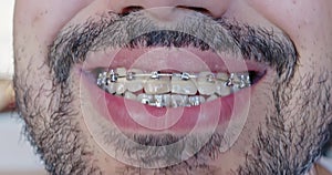 Close-up of a metal bracket system on white, even teeth. Braces for bearded man