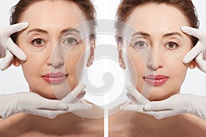 Close up middle age woman macro face before after collagen injection. Face lifting, anti aging concept. Plastic surgery, cosmetic