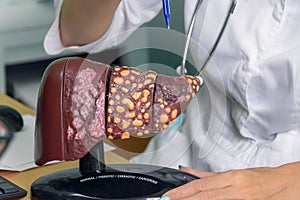 Close up of model of human liver with words normal, fibrotic, cirrhotic, cancerous. female doctor shows the patient a