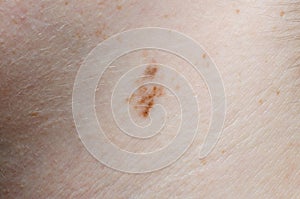 Close-up of a Mole on Human Skin
