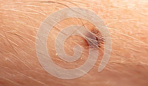 Close-up of a mole on human skin