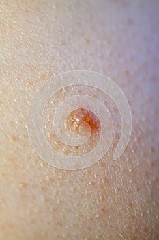 Close up of Molluscum Contagiosum also called water wart photo