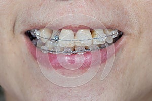 Close-up mouth of crooked teeth with braces