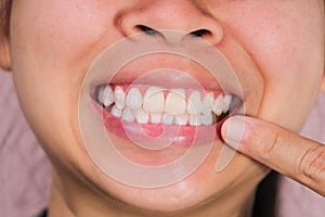 Close up of mouth of happy Asian woman touching the corners of her mouth with index finger while smiling broadly revealing her