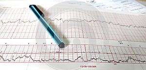 Close up NST paper, medical method for monitoring Fetal heart rate and uterine contractions in pregnancy in hospital.