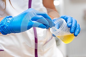 Close up of Nurse Hand holding urine sample container for medical urine analysis with color strip.