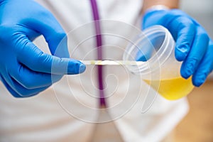 Close up of Nurse Hand holding urine sample container for medical urine analysis with color strip.
