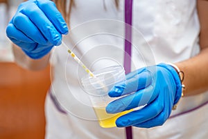 Close up of Nurse Hand holding urine sample container for medical urine analysis with color strip.