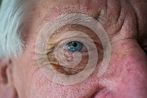 Close up of old mans bruised eye