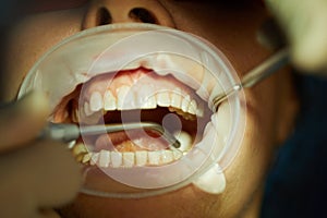 Close-up open mouth with lips holder and dental photo