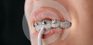Close-up of an oral cavity with braces and an irrigator.