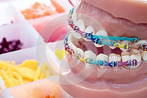 Close up orthodontic model.