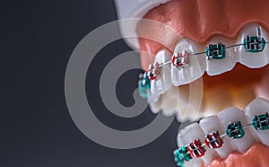 Close-up of a orthodontic model jaws and teeth with braces