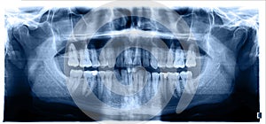 Close up. Panoramic image of the jaw, primary adentia of the third molar. Medical examination of teeth, maxillofacial surgery