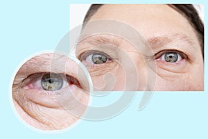 close-up part face middle-aged woman in two versions, puffiness under lower eyelid, wrinkles on skin, concept allergies, kidney photo