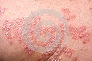 Close up part of human skin affected by psoriasis