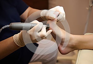 Close-up of a patient visiting podiatrist, on medical pedicure procedure, receiving hardware peeling procedure with electric