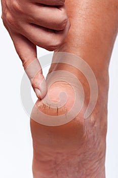 Close-up of a person's cracked heels