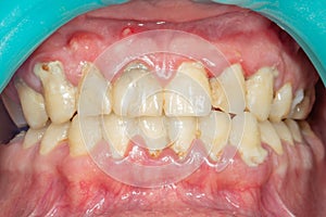 Close-up of a person`s teeth after removing and cleaning a plaqu