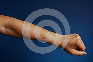 Close-up of persons injured arm with misshapen elbow against a blue background, A misshapen elbow, showing signs of significant photo