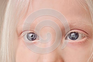 Close-up photo of albino child eyes