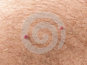 Close up photo of cherry angioma on human skin