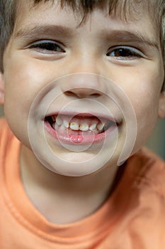 Close up photo of child dental caries. Kid open mouth showing cavities teeth decay.