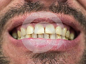Close-up photo with focus in the middle of the male part of the face with a grin with a plaque on the teeth