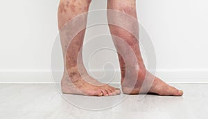 Close up photo of legs with lymphostasis and psoriasis.