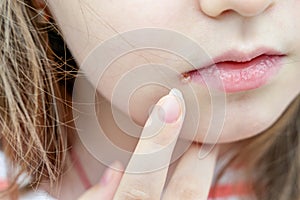 Close up photo of little girl lips affected by herpes. Treatment with ointment