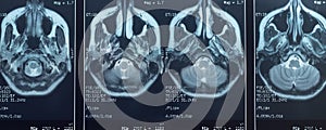 Close-up photo of an MRI of the skull and brain of a person with severe headaches; magnetic and nuclear resonance as a diagnostic