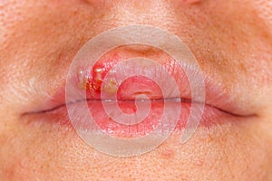 Oral herpes simplex virus infection photo