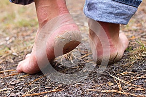 Close up photo pair of cracked heels. Male back view.