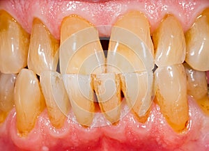 Porcelain, zirconia teeth in human mouth photo