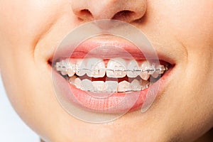 Healthy smile woman with clear brackets photo