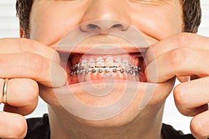 Close-up picture of man showing dental braces photo