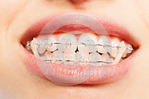 Teeth with dental braces and elastics full mouth photo