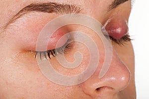 Upper eyelid infection - chalazion photo
