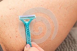 Foliculitis on hairy skin - shaving photo