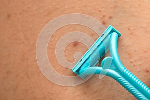 Foliculitis on hairy skin - shaving with razor photo