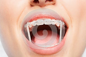 Woman mouth with orthodontic elastics on braces photo