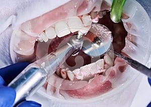 Close-up picture of a woman`s mouth during dental procedure of cleaning teeth