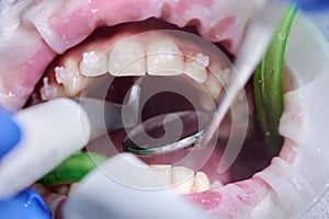 Close-up picture of a woman's mouth during dental procedure of cleaning teeth