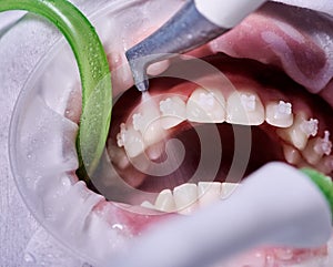 Close-up picture of a woman's mouth during dental procedure of cleaning teeth