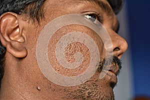 Close up of pimples marks on man`s face . Deep acne scars on the cheek
