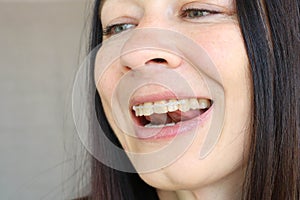 Close up portrait of smiling woman with orthodontic elastic chain on teeth looking sideways and palpating her teeth