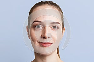 Close up portrait of woman`s face divided into two parts: healthy pure skin and unhealthy with blackheads, contrast between two sk